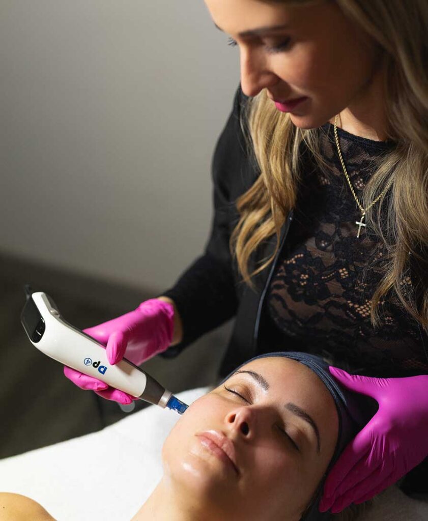 Microneedling Beauport