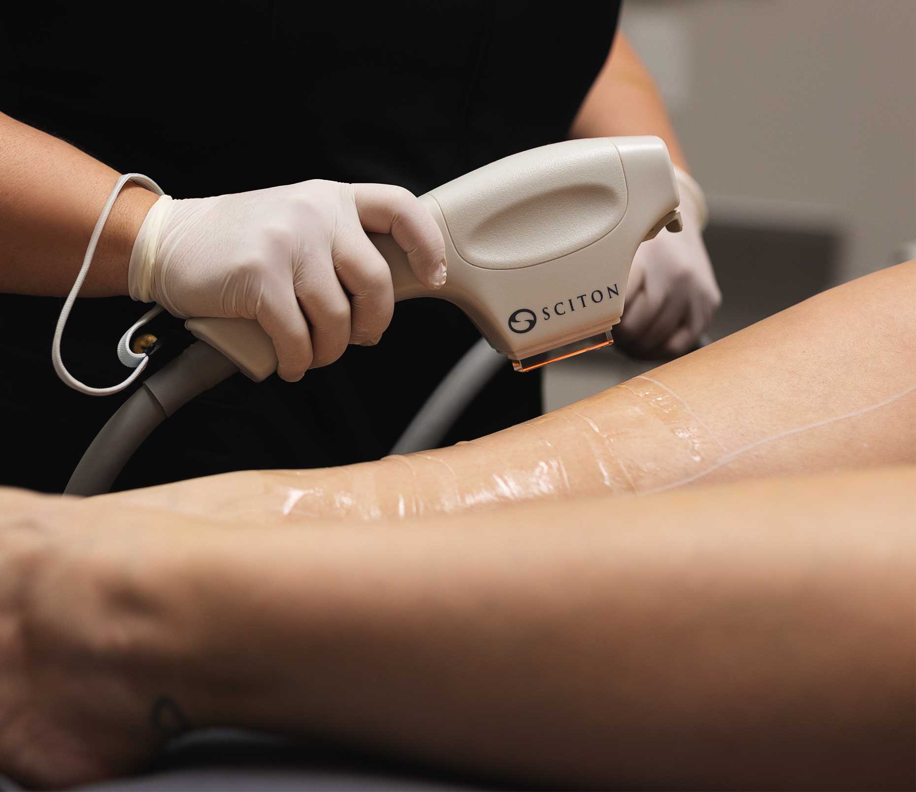 Épilation Sciton IPL