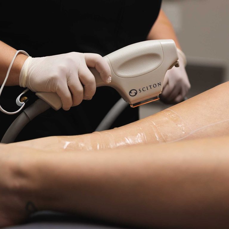Épilation Sciton IPL